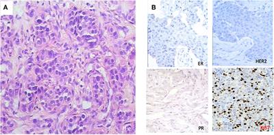 Polyoxidonium® Activates Cytotoxic Lymphocyte Responses Through Dendritic Cell Maturation: Clinical Effects in Breast Cancer